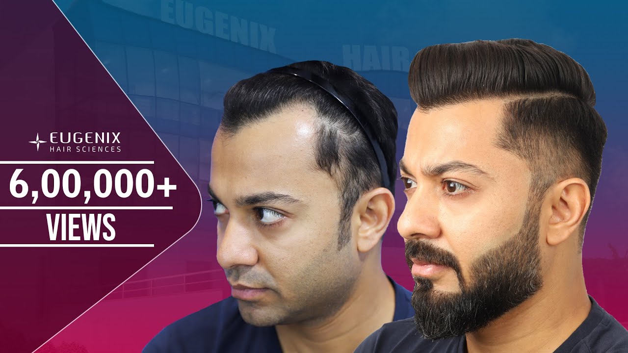 The best Hairline Ever recreated | Best Hair Transplant result | Journey Explained by Patient