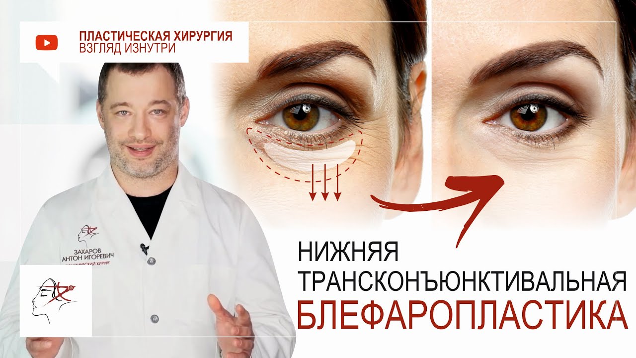 Нижняя трансконъюнктивальная блефаропластика