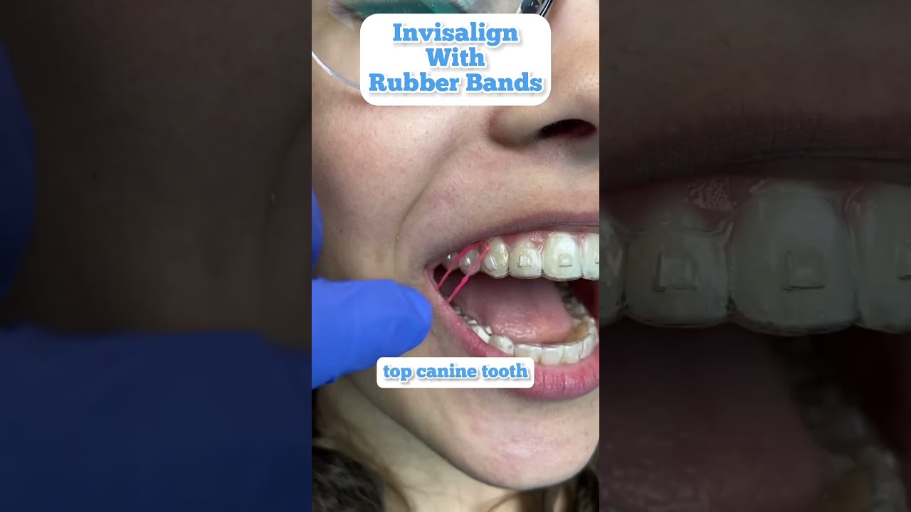 Can rubber bands be used with Invisalign? Spoiler alert: YES!