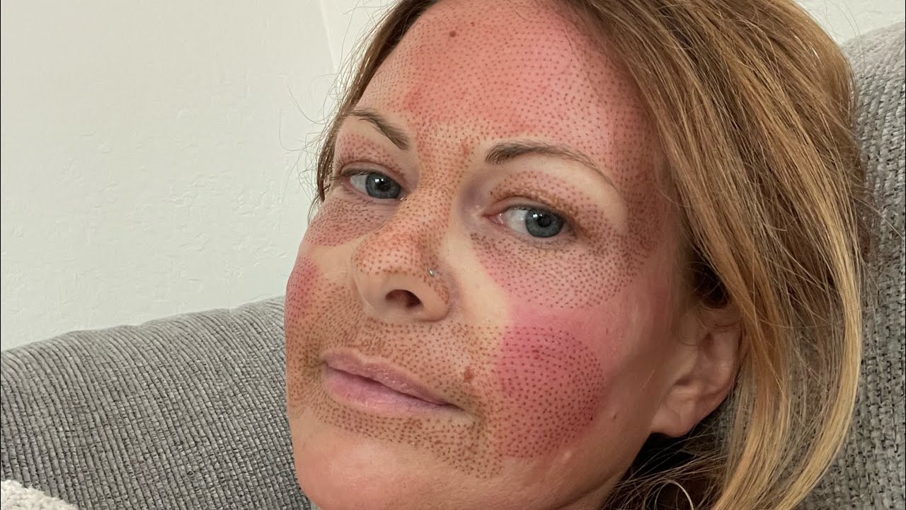 Lindsay’s Fibroblast Plasma treatment and the healing process