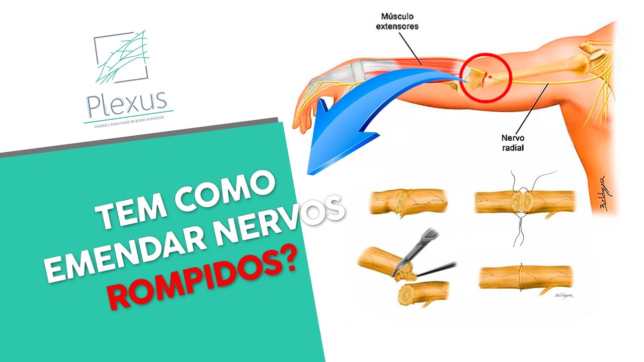 Neurorrafia - Emendando nervos rompidos com micro suturas