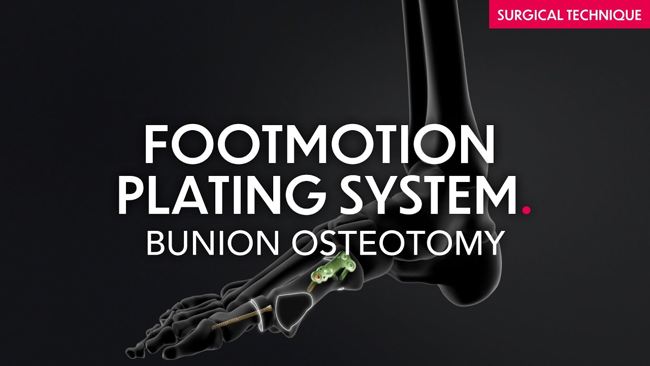 Footmotion Plating System - Mini Invasive Bunion Osteotomy - Surgical technique
