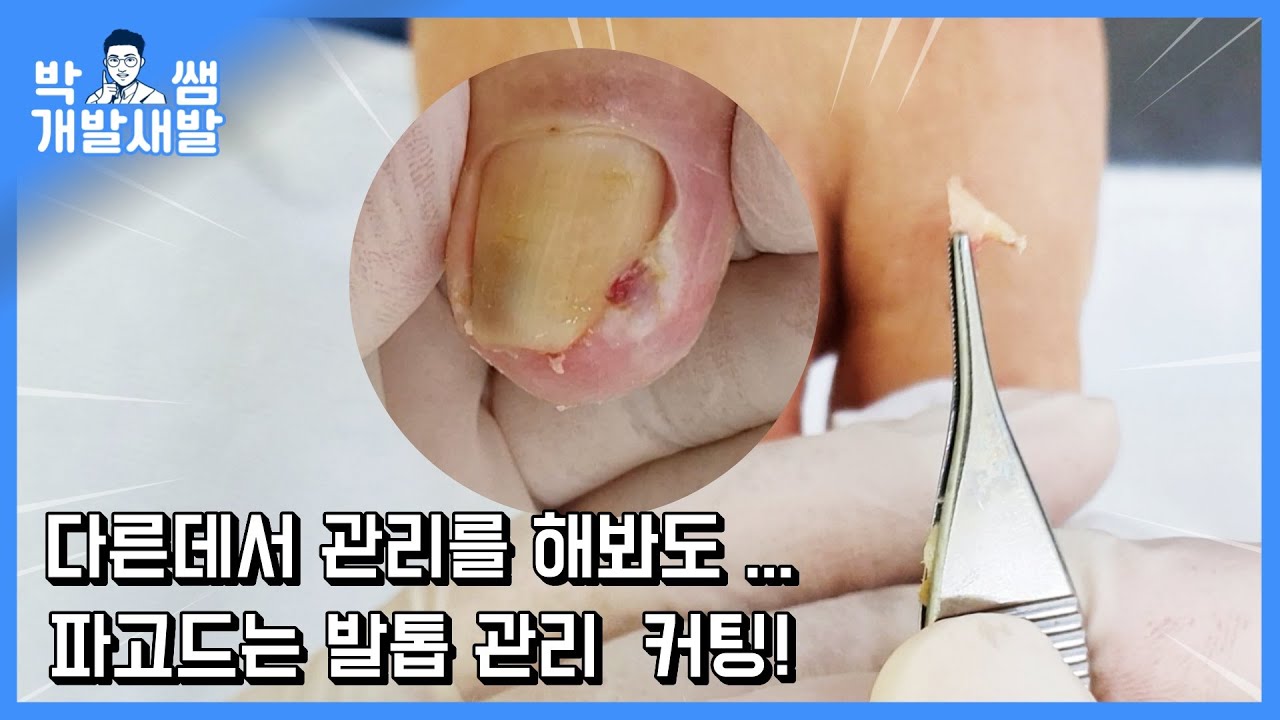 파고드는 발톱 제거 관리 여기저기 다녀봐도 좋아지질 않았어요