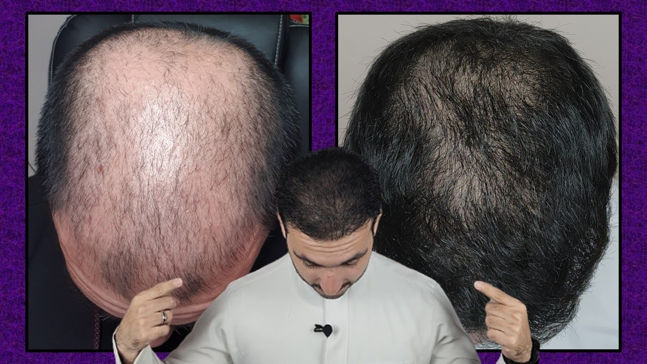 تجربة زراعة الشعر بالكامل من أول يوم إلى بعد سنة