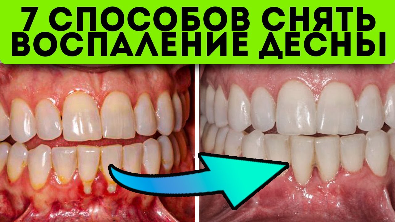 Десна кровоточили, не ел 3 суток, пока&hellip; простой народный рецепт от воспаления десен