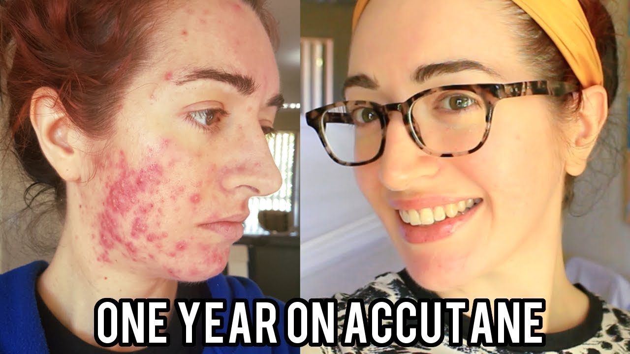 ACCUTANE: Before And After Severe Acne (With Pictures) My Experience | Jess Bunty