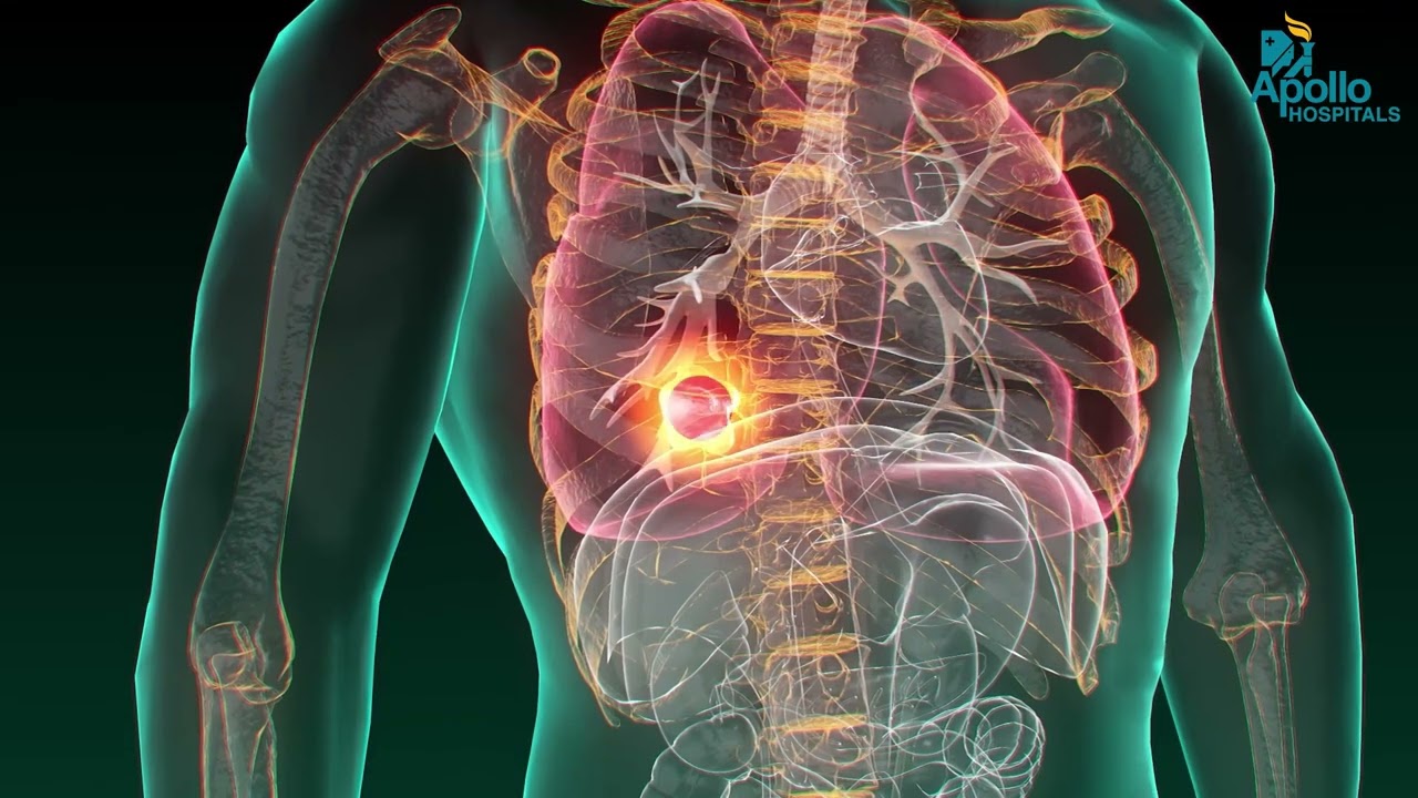 အဆုတ်ကင်ဆာ | Dr Sridhar R | Apollo Hospitals