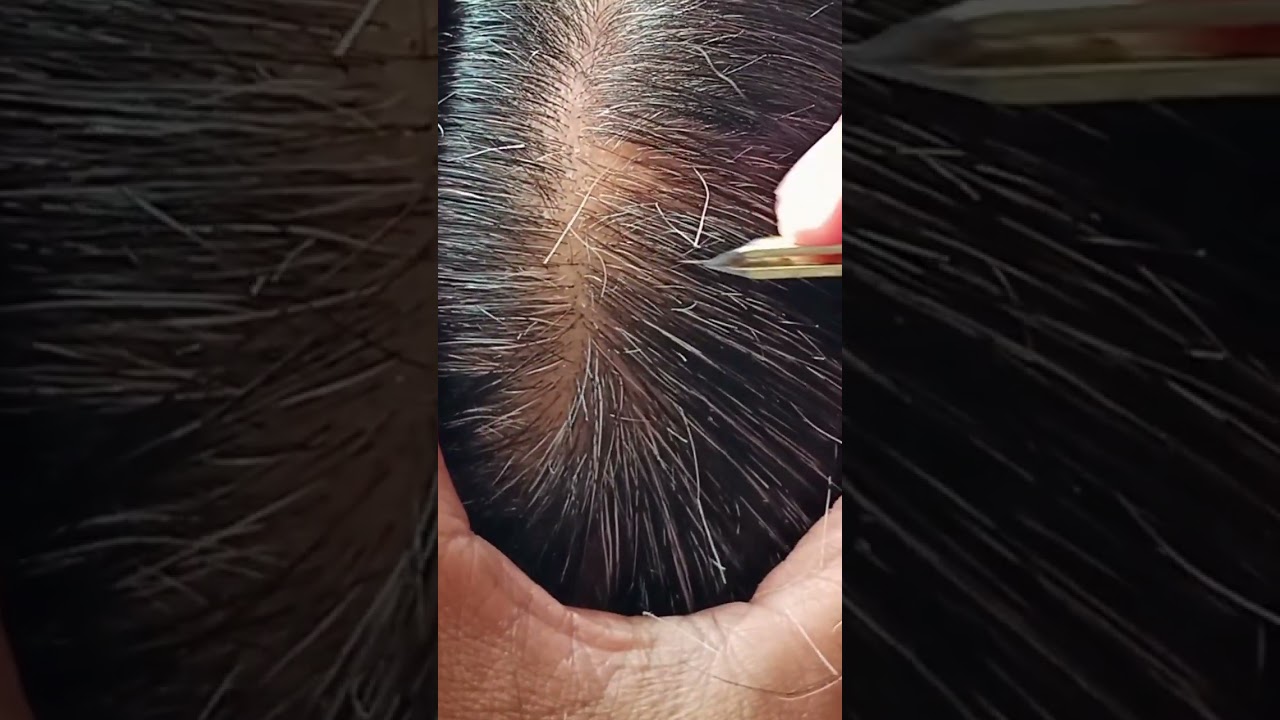Most satisfying white hair removal 0.28#satisfying #hairremoval #musicbackground