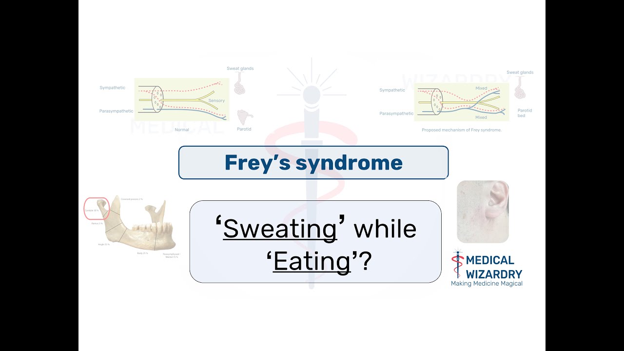 Frey's syndrome -  Sweating While Eating