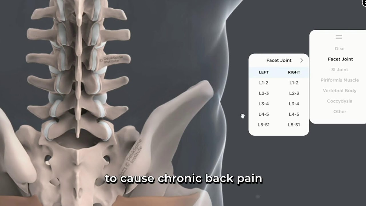 Lumbar Deuk Plasma Rhizotomy L3-S1 for Lower Back Pain from Facet Joint Arthropathy