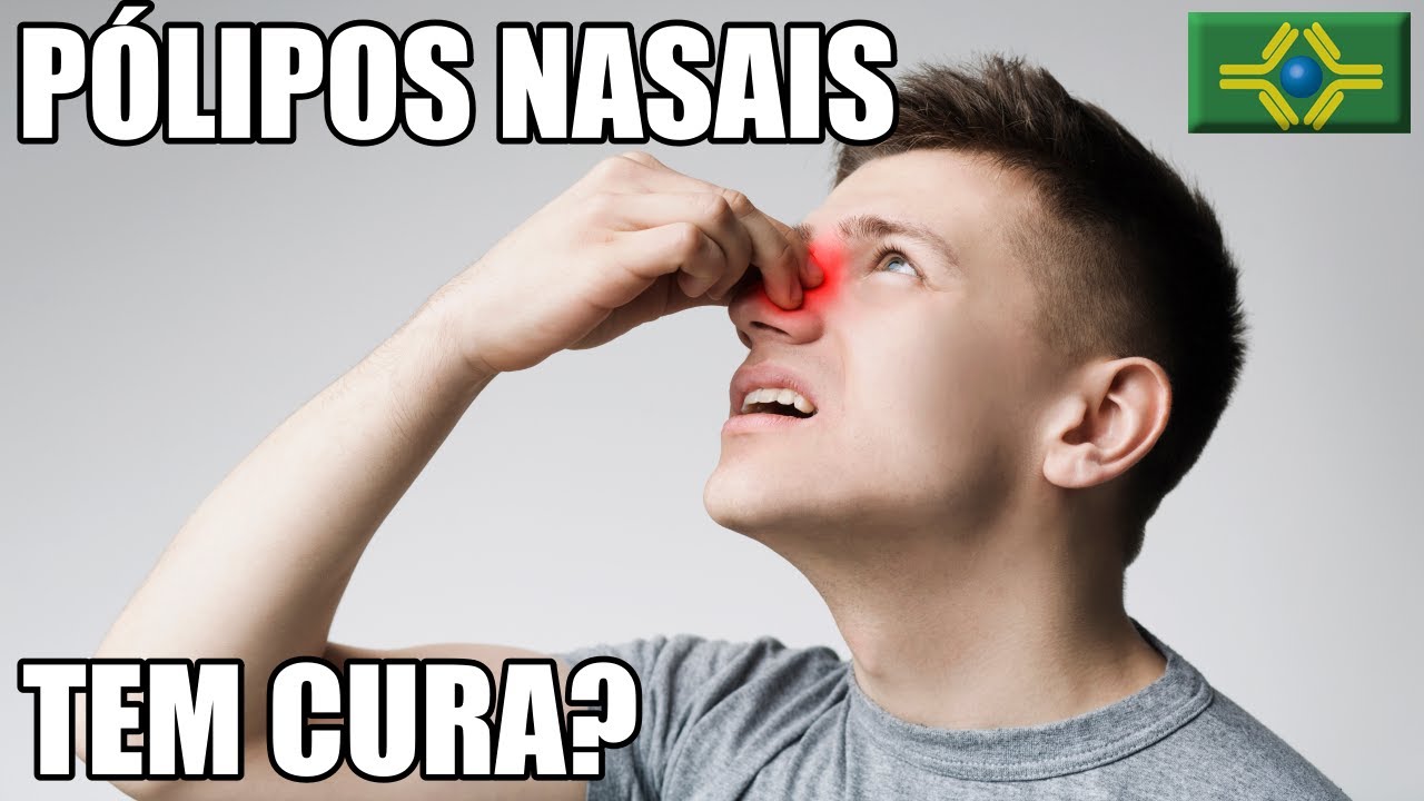 Retirei PÓLIPOS NASAIS mas continuo com ANOSMIA PERDA DO OLFATO-Esse problema tem CURA? | # ALERGIA