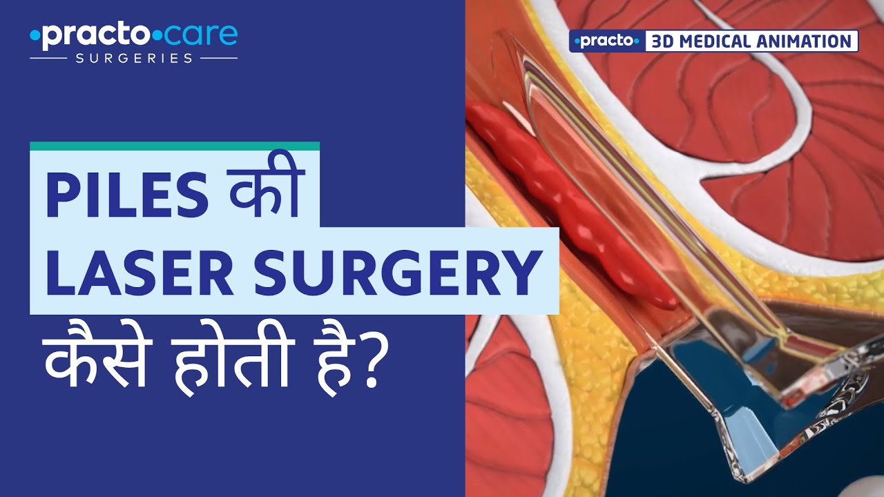 Piles Laser Surgery | Procedure Animation | Best Treatment for Piles | Practo Care Surgeries