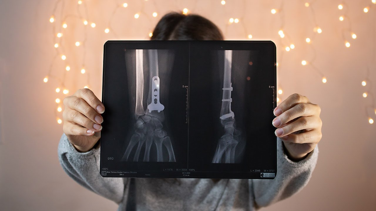 My story with Kiënbock's disease!