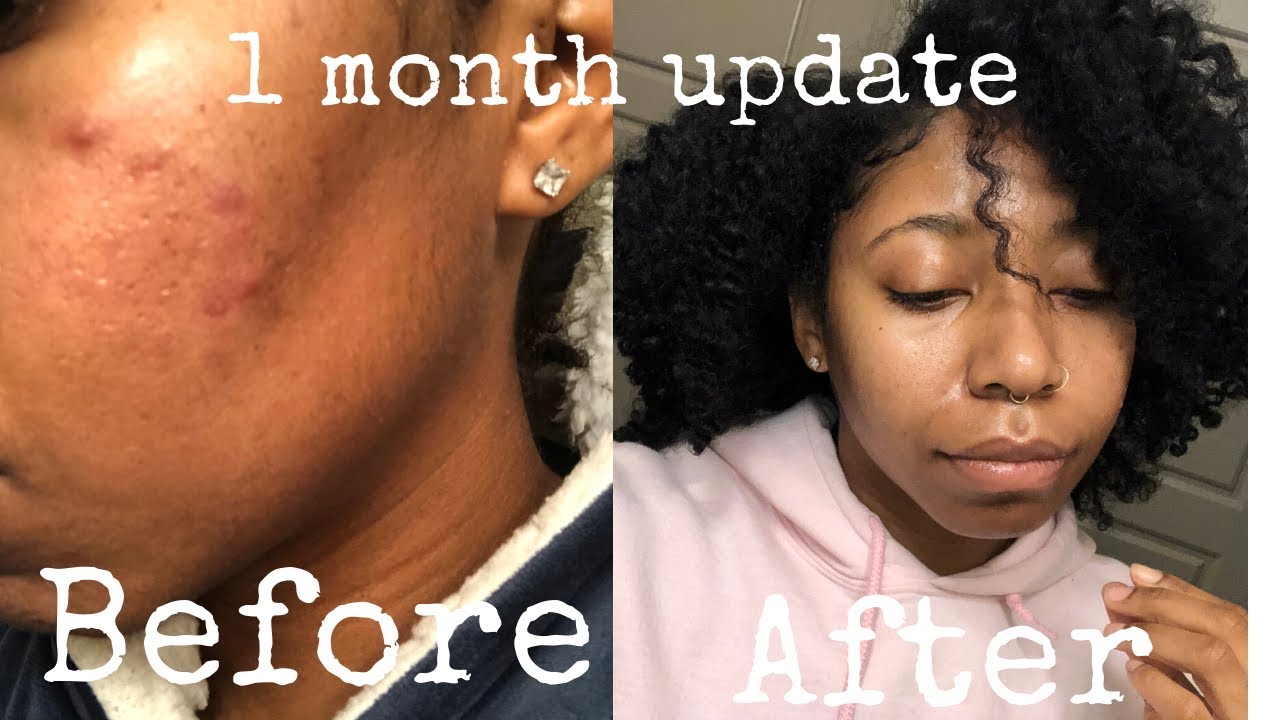 Urban Skin RX Clear Skin Bar 1 Month Review | Pictures Included | Ri's Remedies