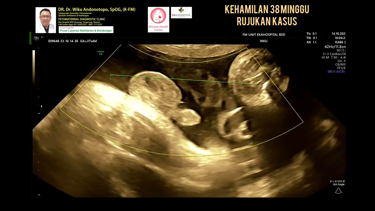 Kehamilan 38 minggu Rujukan di penghujung kehamilan