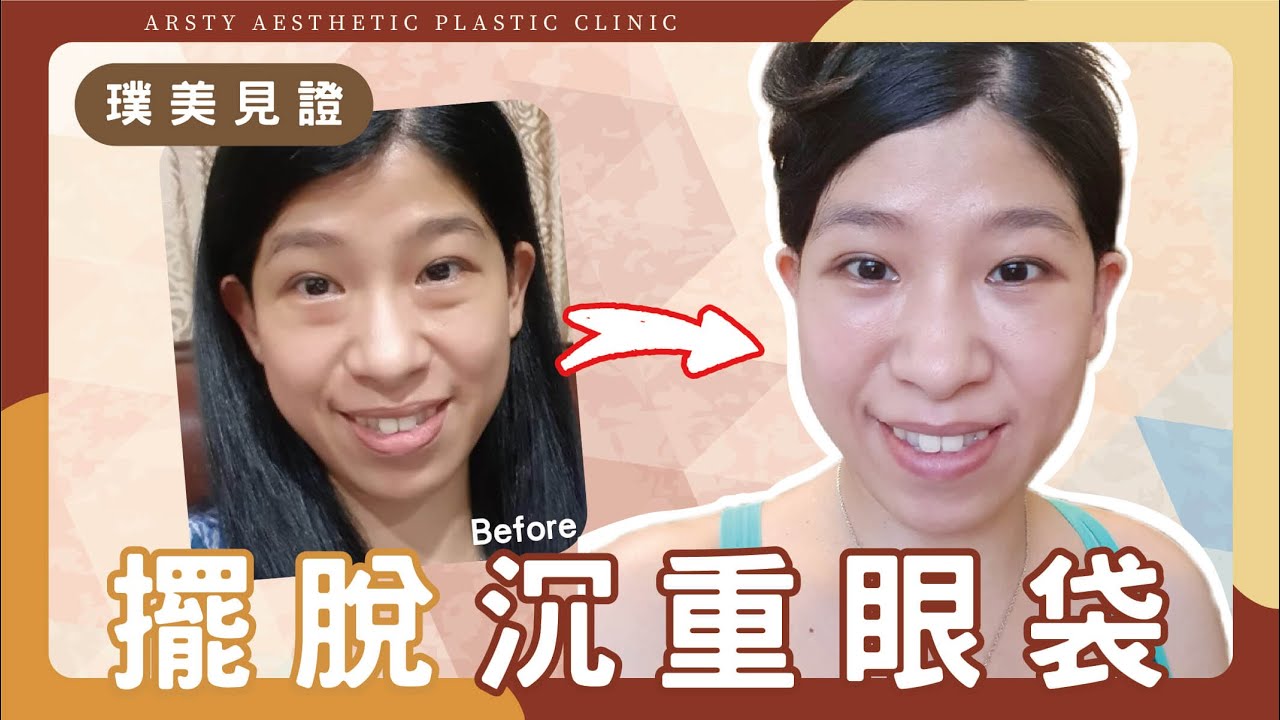【眼袋手術】擺脫浮腫，找回有神雙眼 | 璞美整形外科醫美診所