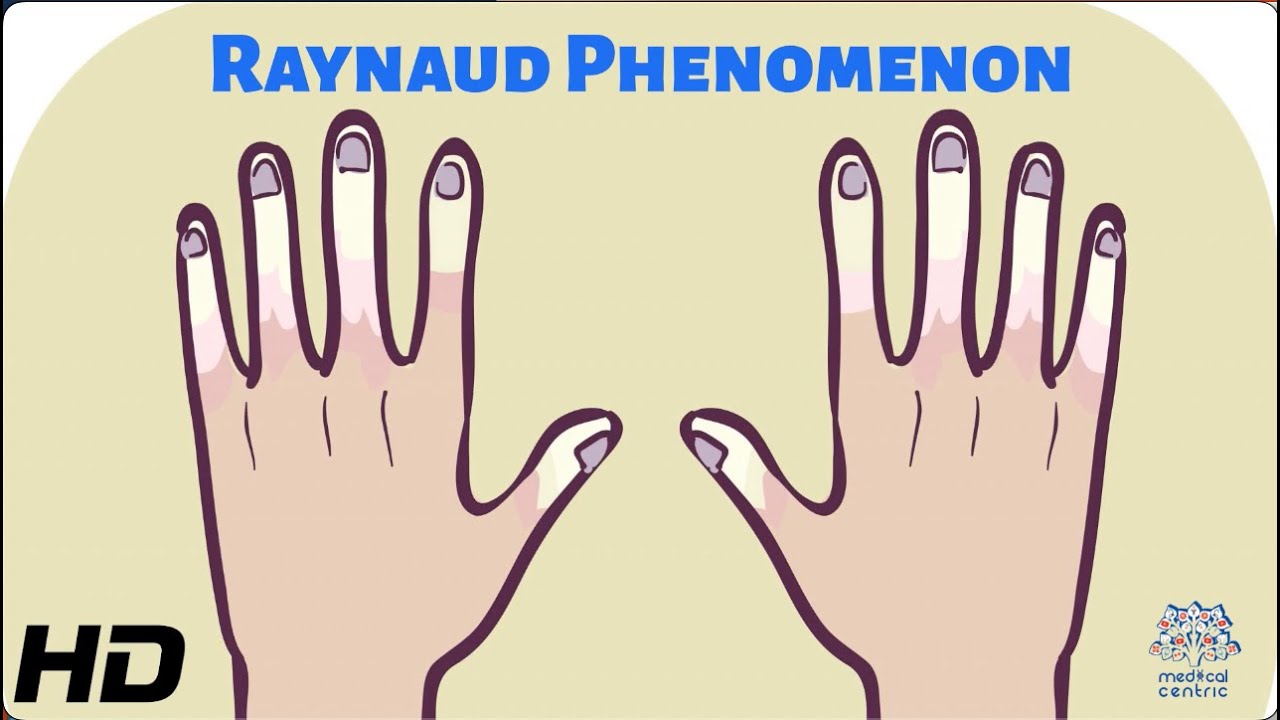 Blue Fingers and Toes: Understanding Raynaud Phenomenon