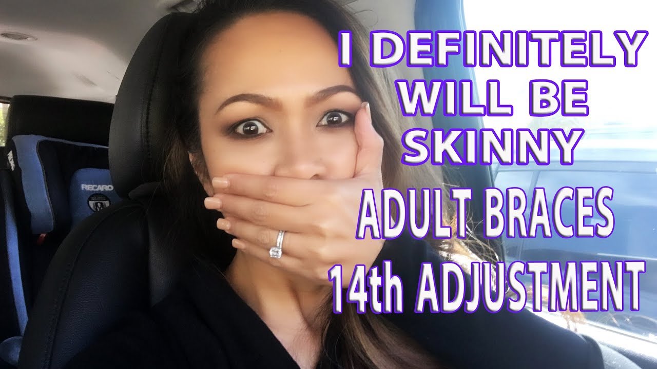 LIFE VLOG: ADULT BRACES 14th ADJUSTMENT | HOW CAN I EAT NOW?! | ARREM