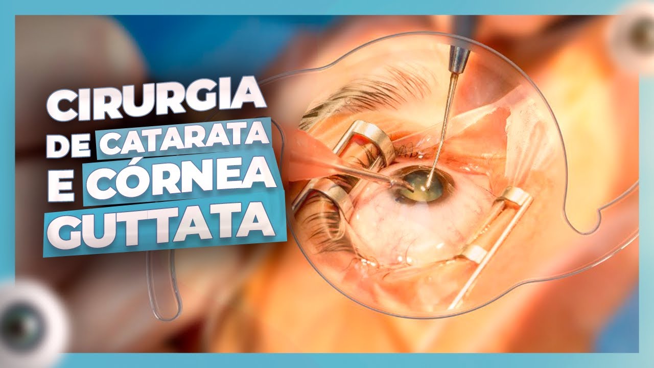 CIRURGIA DE CATARATA E CÓRNEA GUTTATA | Dr. Gustavo Bonfadini