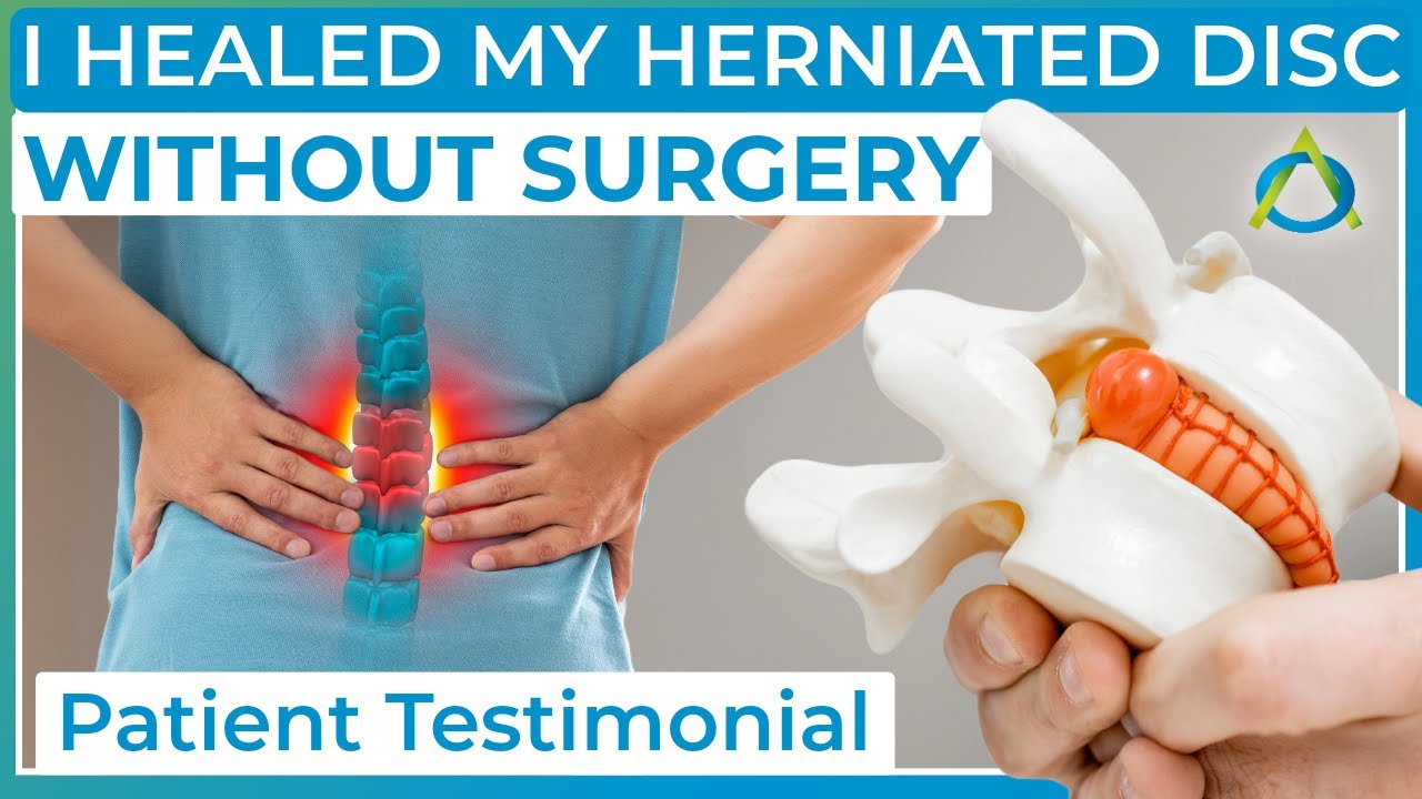 DISCSEEL Procedure Reviews - Patient’s Experience - Can a Herniated Disc Heal Naturally?