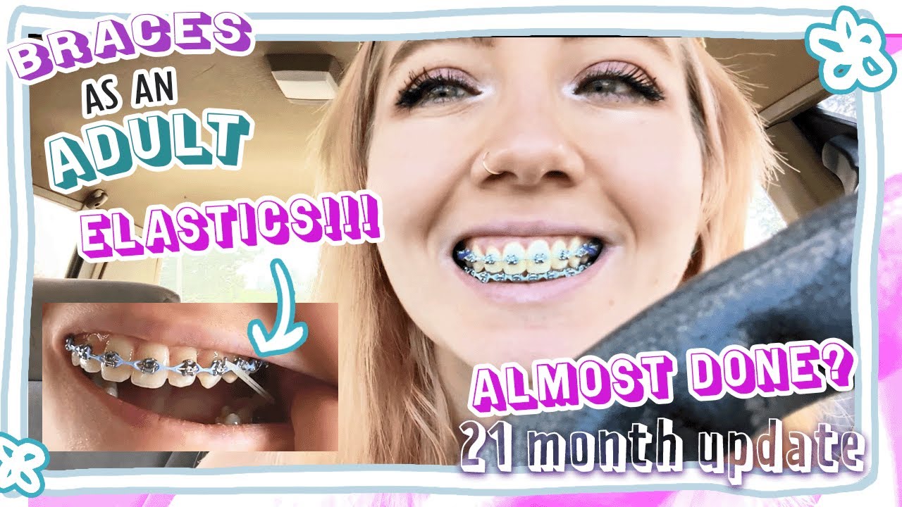 21 Month Update: Finally ELASTICS! | Braces as an Adult