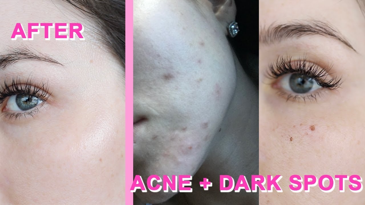 PHOTOFACIAL Before & After | Nicole Masifilo