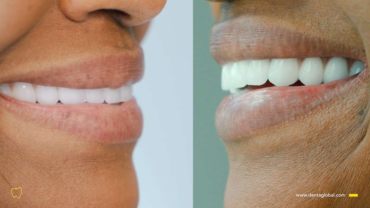 Here, you can take a look at an all-done All-On-4 treatment. 😎 See how good they look! 😍