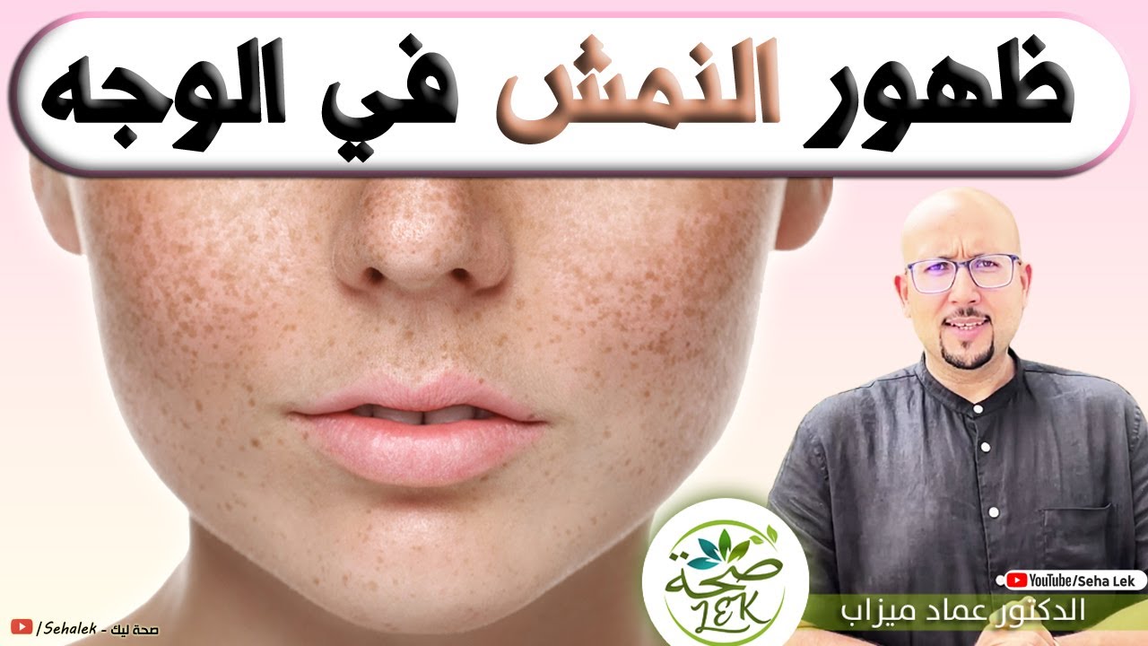 النمش أسبابه ووصفات طبيعية لعلاجه / د. عماد ميزاب wasafat doctor imad mizab