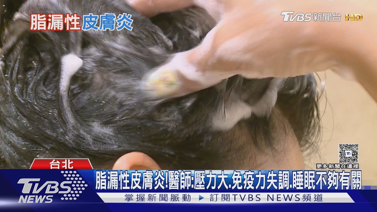 脂漏性皮膚炎!博士生熬夜 頭皮掉屑超過十年 醫師:「這治療」救了他!｜十點不一樣20250612 @TVBSNEWS01