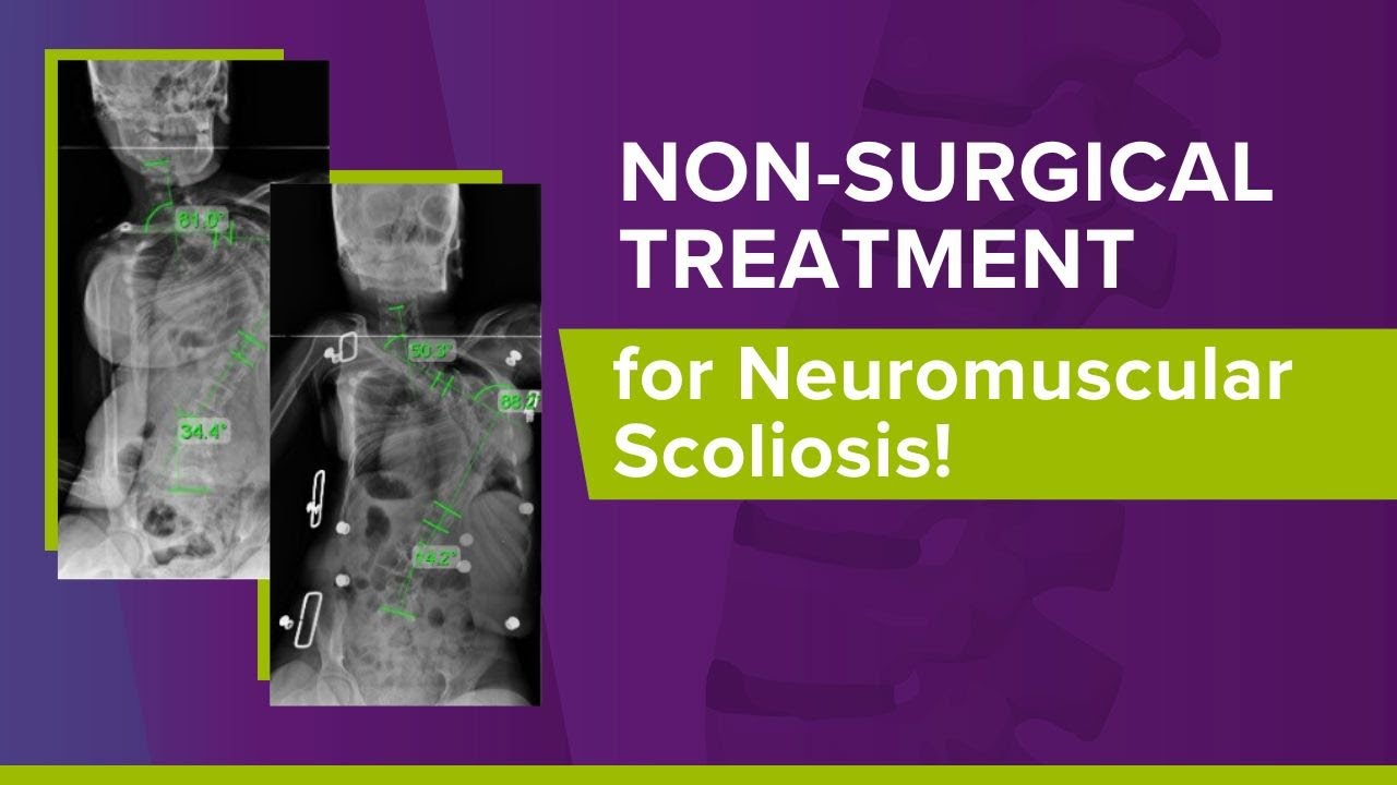 Non-Surgical Treatment for Neuromuscular Scoliosis!