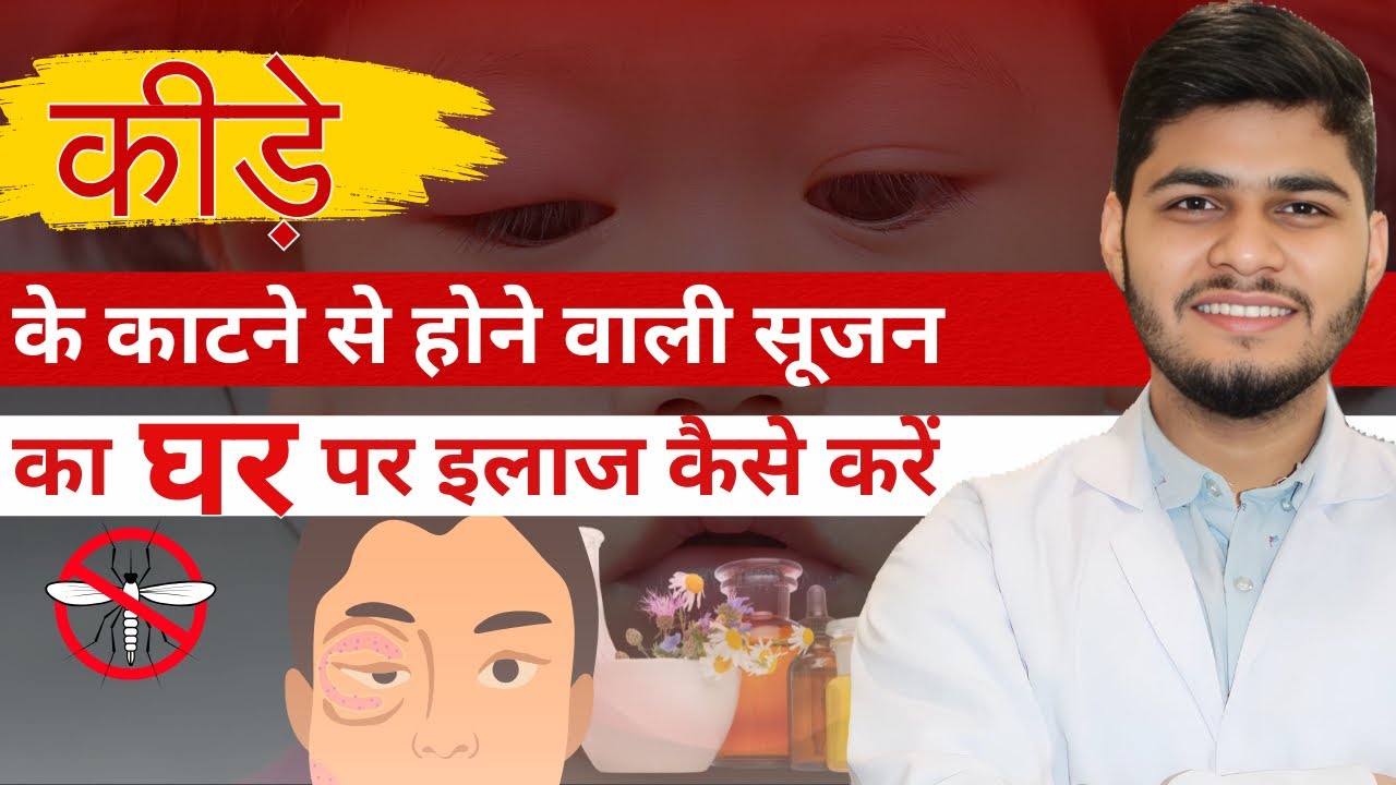Insect Bite Treatment | How to treat insect bite swelling | कीड़े के काटने पर होने वाली सूजन