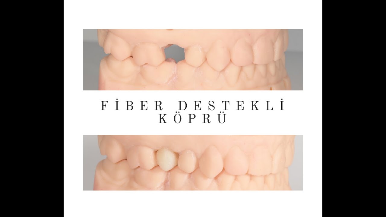 Fiber Köprü ile Eksik Diş Tedavisi