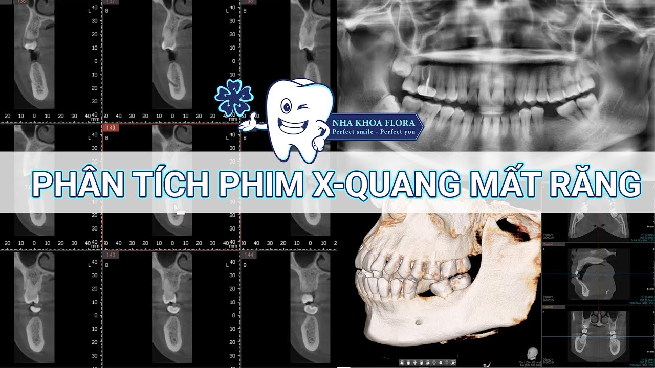 Phân tích phim X quang trước khi cấy ghép Implant