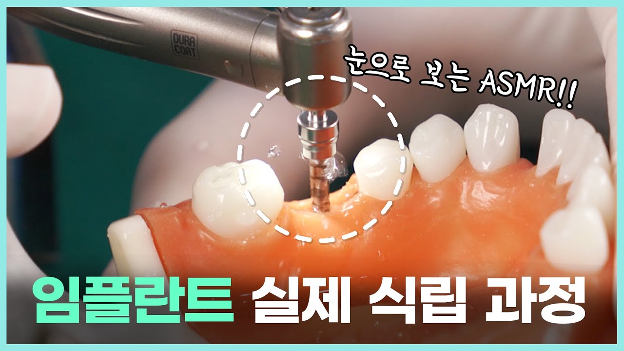 실제 오스템 임플란트 수술 과정 공개! ㅣ 임플란트 종류와 임플란트 심는 전 과정 그리고 기구까지!
