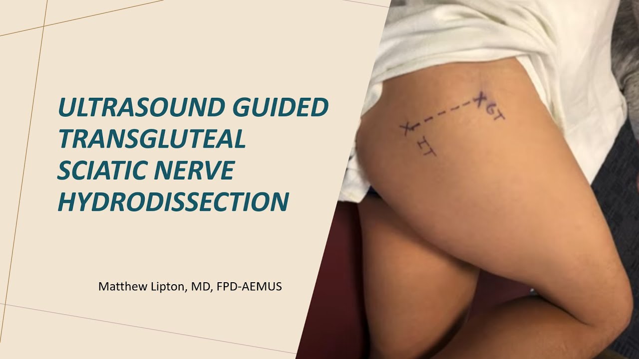 Transgluteal sciatic nerve hydrodissection: the new procedure to treat sciatica in the ED?