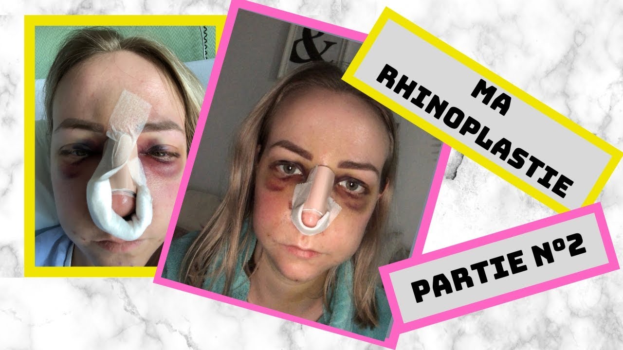RHINOPLASTIE PARTIE 2, DOULEUR/INSOMNIE/RESULTAT