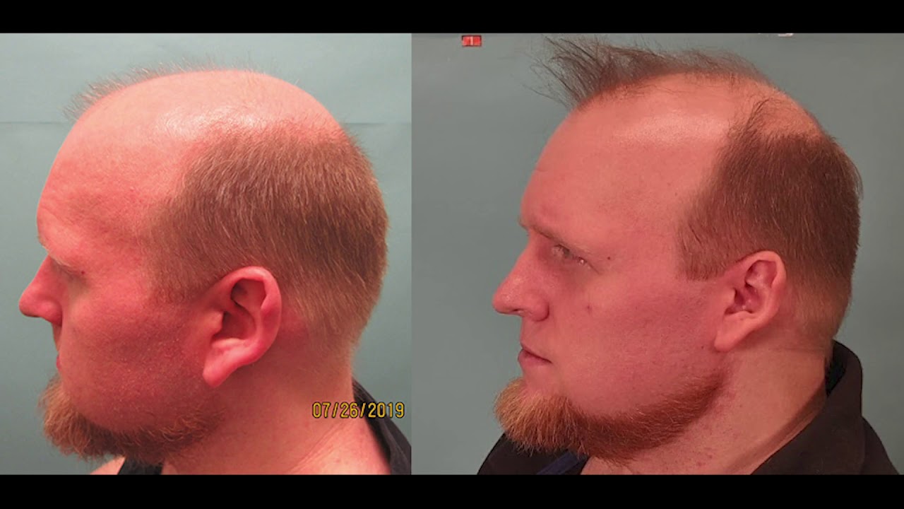 Extracellular Vesicles (EV) for Hair Growth - Patient's Hair Loss Journey