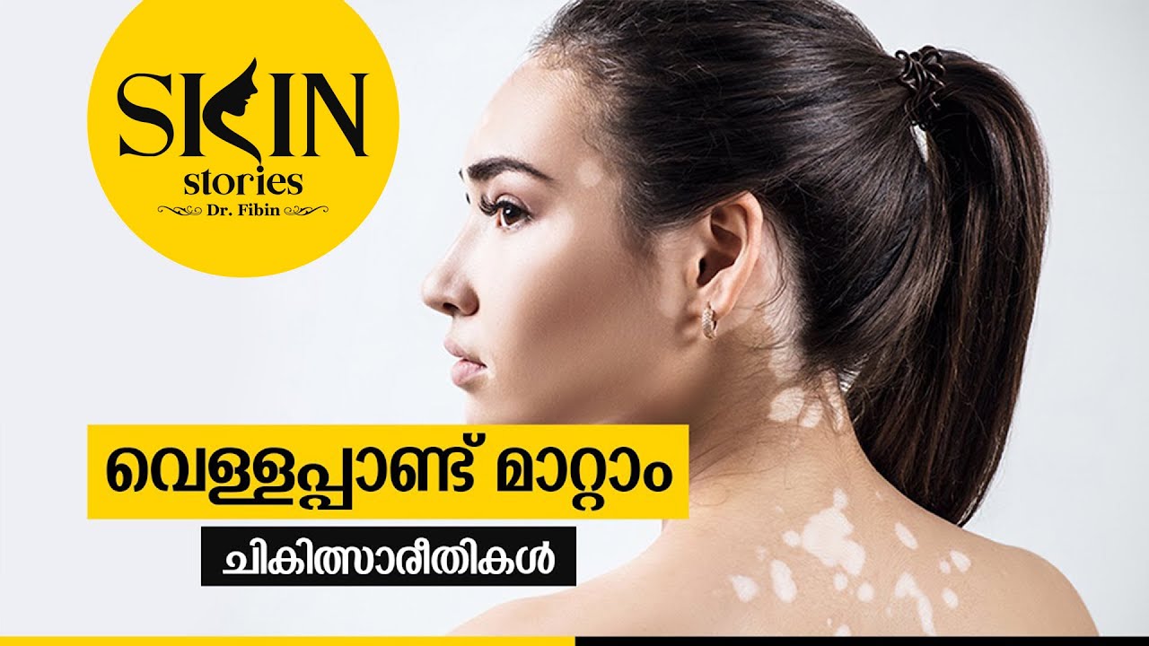 വെള്ളപ്പാണ്ട് മാറ്റാം - ചികിത്സാരീതികൾ | Vitiligo & It's Treatment | Dr. Fibin | Skin Stories #07