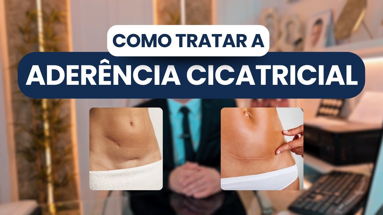 COMO TRATAR A ADERÊNCIA CICATRICIAL?! | DR VALDERI VIEIRA