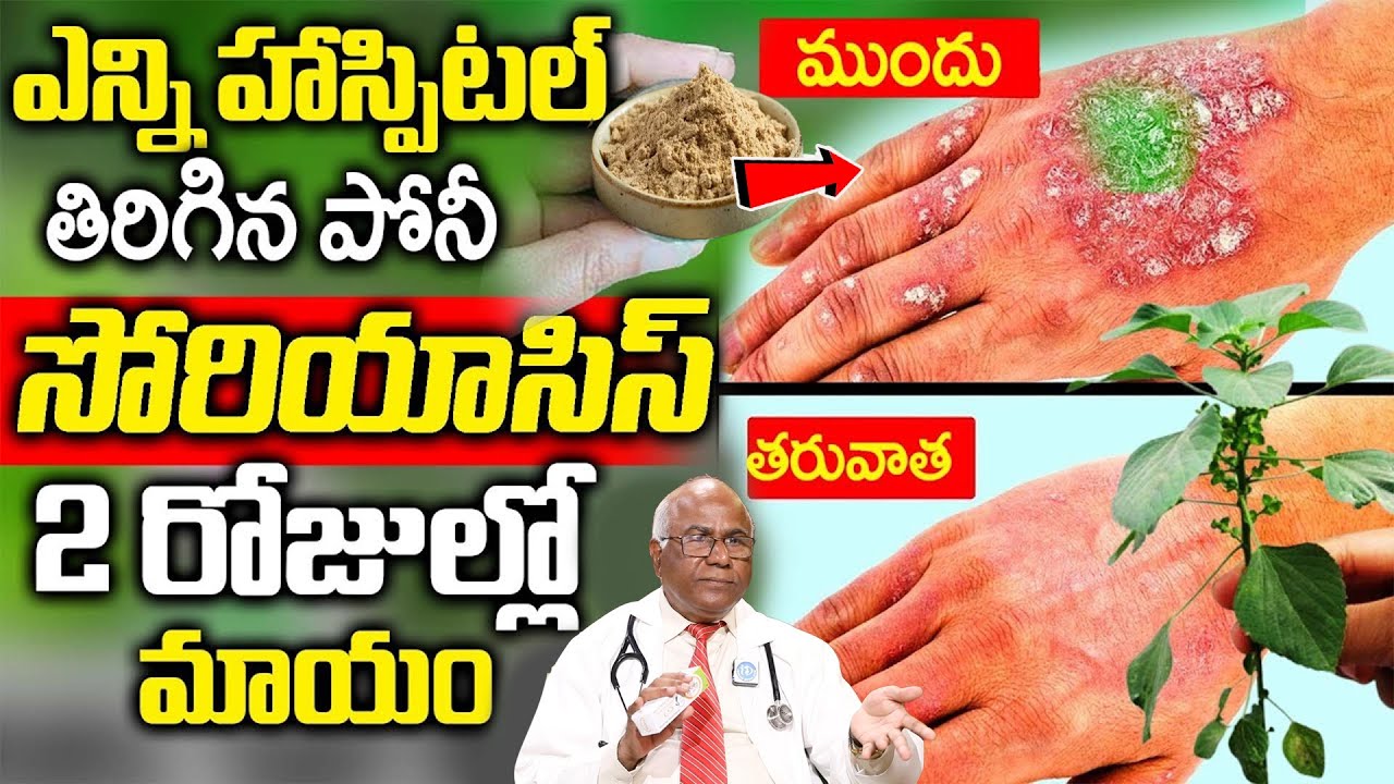 ఆముదం + కానుగ గింజల నూనె 4 రోజుల్లో సోరియాసిస్ మాయం, మరక కూడా మరక కూడా కనిపించదు|Dr. CL Venkata rao