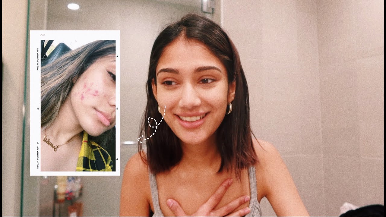 HOW I CLEARED MY ACNE | MY SKIN JOURNEY