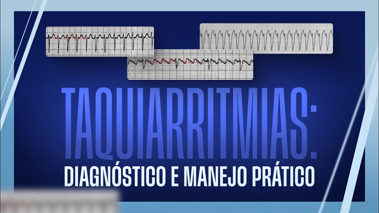 Taquiarritmias: Diagnóstico e Manejo Prático