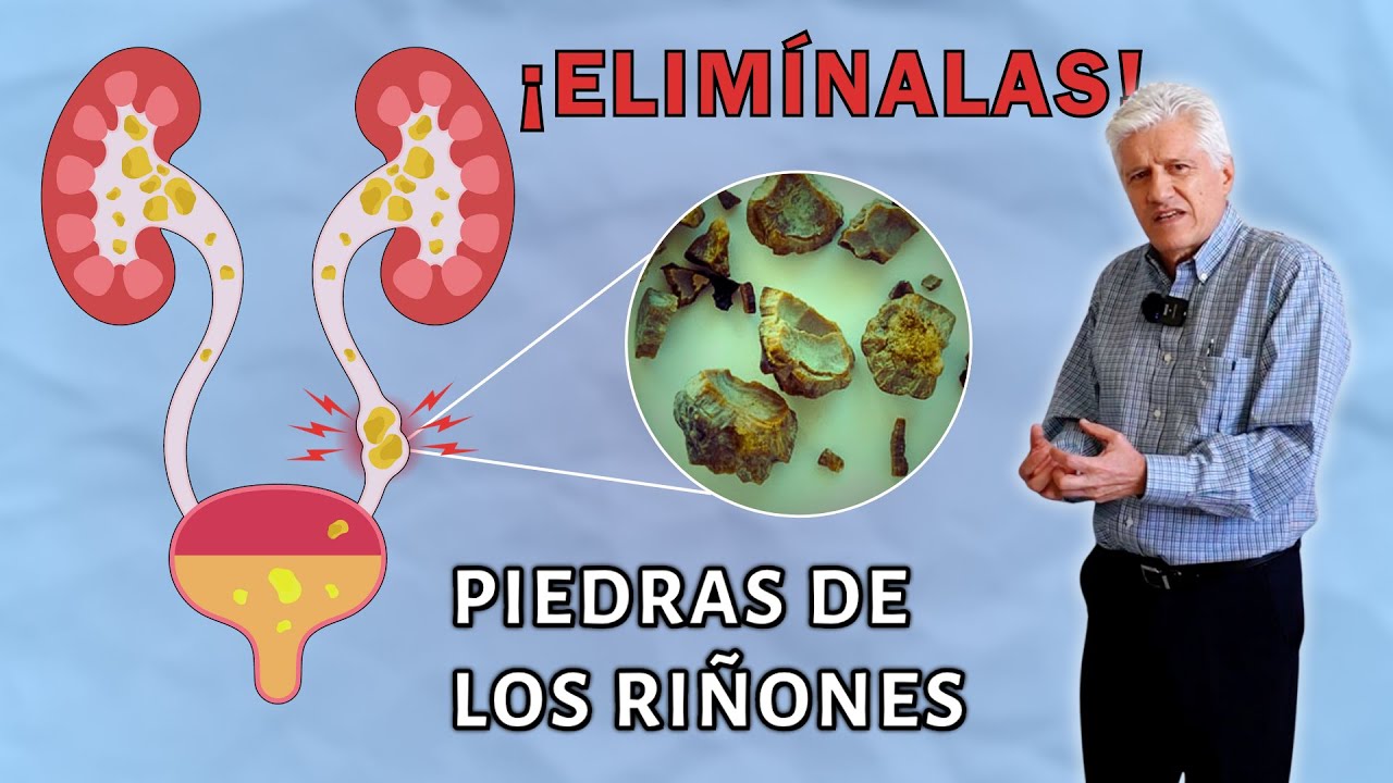 ¿Cómo EVITAR la formación y reaparición de CÁLCULOS RENALES? | LITIASIS RENAL🪨