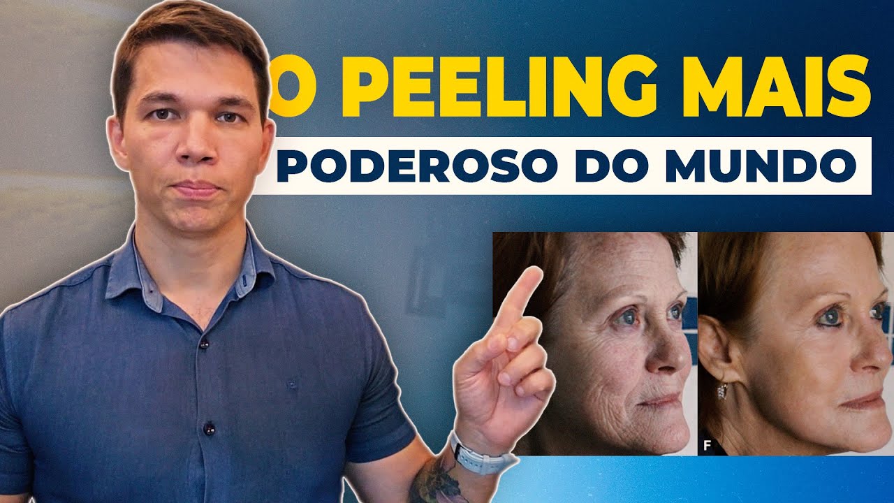 Peeling de Fenol: O mais poderoso para o rejuvenescimento do rosto