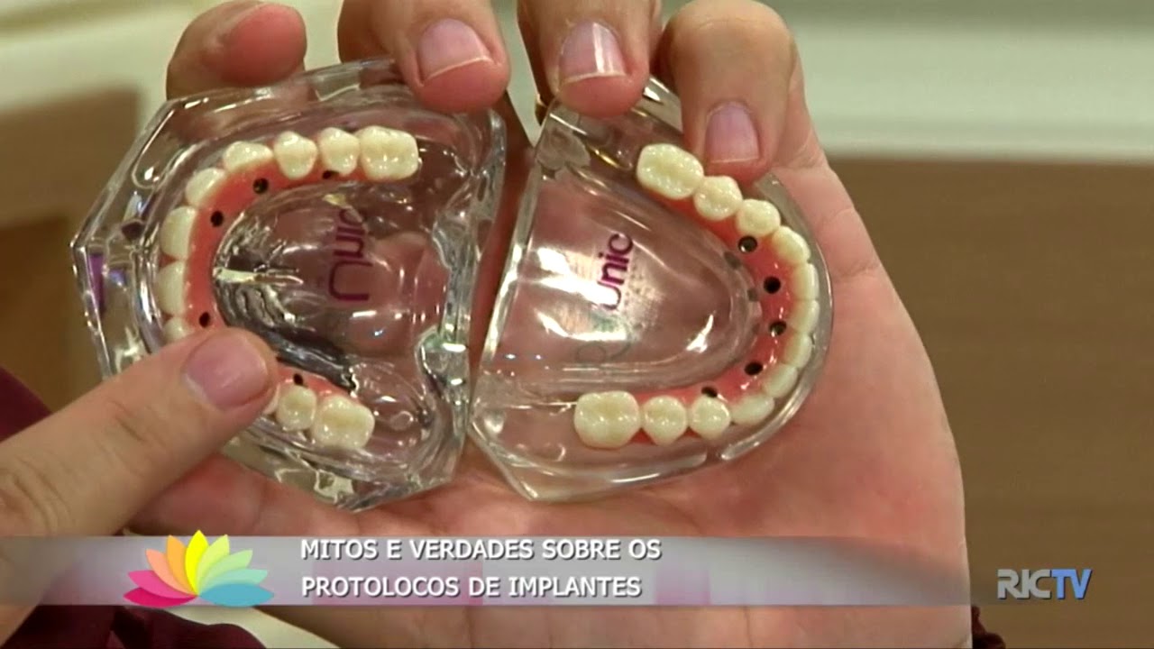 Mitos e verdades sobre os protocolos de implantes