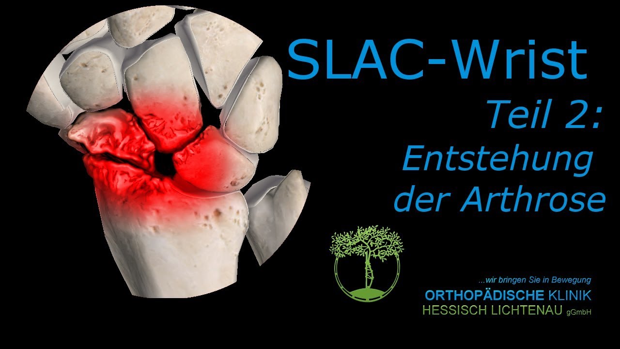 SLAC 2  Teil