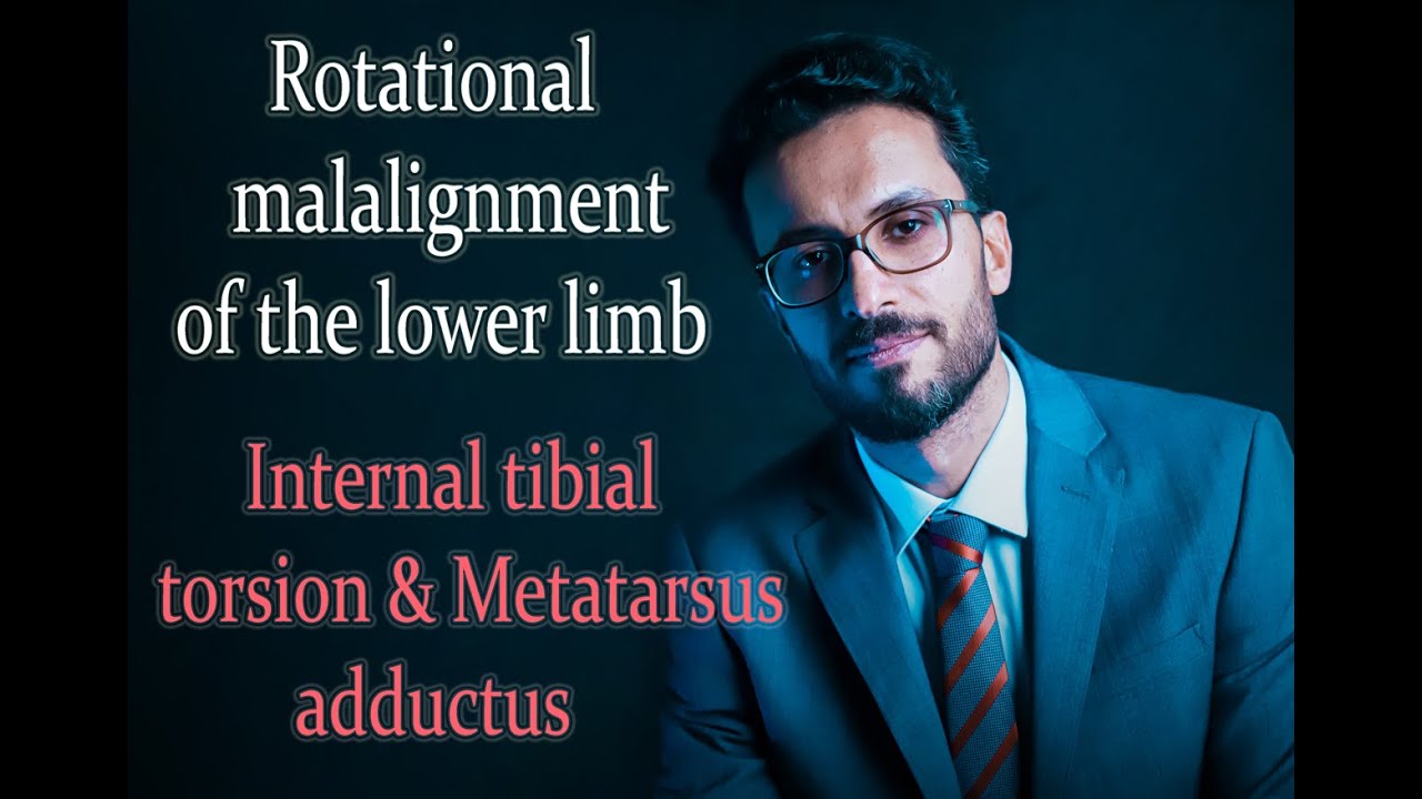 02  Rotational malalignment of the lower limb: Internal tibial torsion & Metatarsus adductus