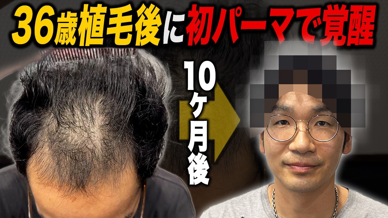 【薄毛卒業】植毛10ヶ月目の36歳が初パーマで人生変わった