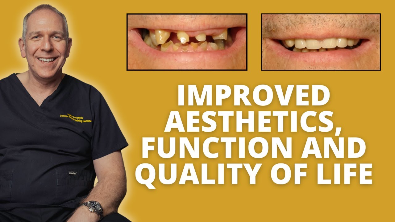 Restorative Solutions for Severe Tooth Wear