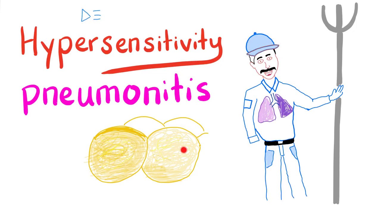Hypersensitivity Pneumonitis | Restrictive Lung Diseases | Pulmonology